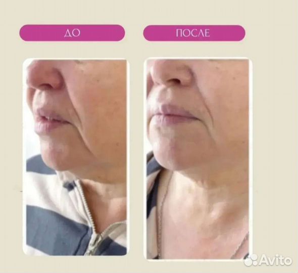 Контурная пластика