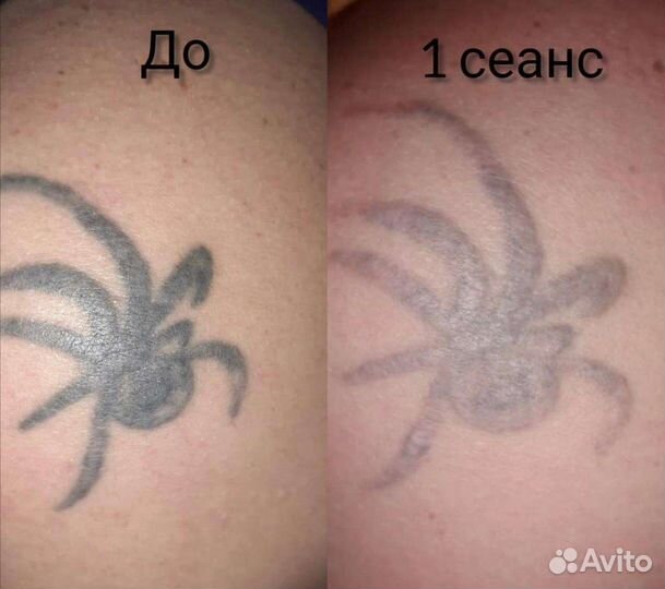 Удаление тату/татуажа лазером