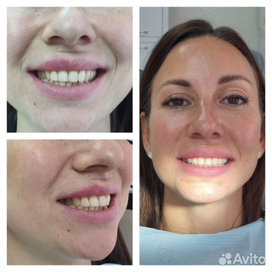 Исправление прикуса элайнеры брекеты