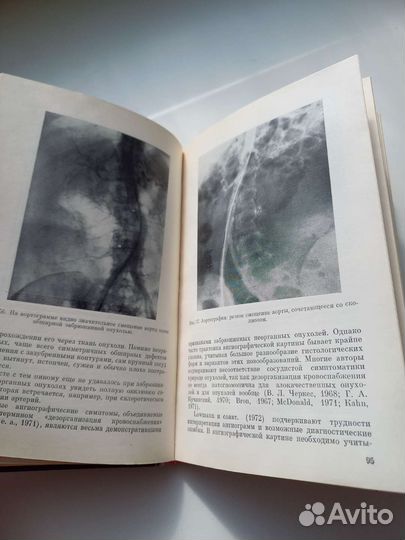 Книга СССР забрюшные опухоли медицина 1976г