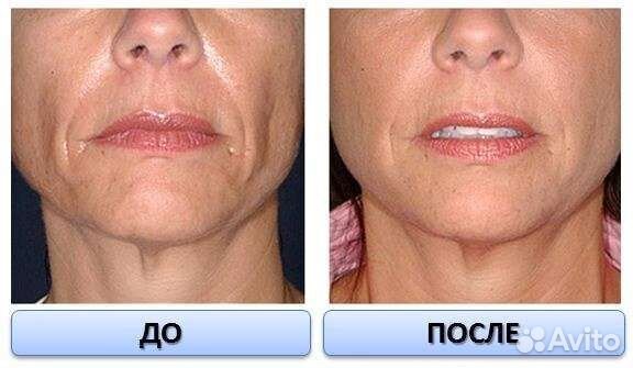 Косметолог плазмолифтинг,ботокс,увеличение губ