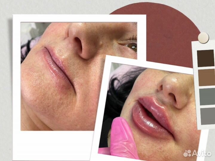 Увеличение губ, скулы, ботокс, плазмолифтинг