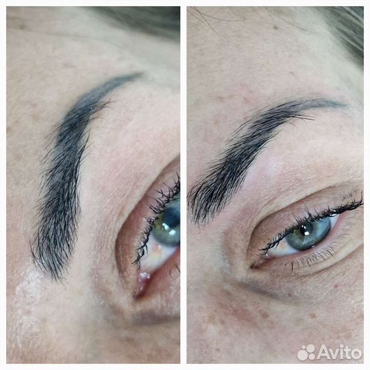 Лазерное удаление татуажа