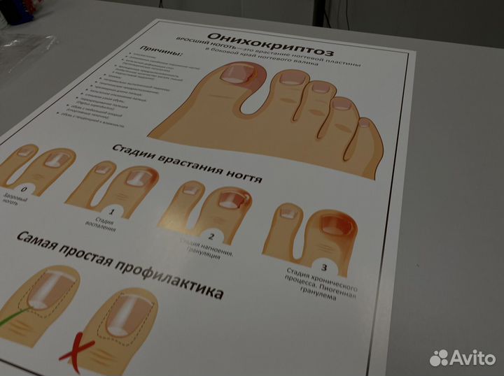 Плакат онихокриптоз