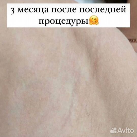 Лазерная эпиляция