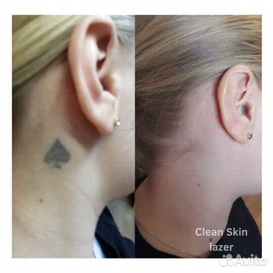 Модель на Удаление тату / Перманентного макияжа