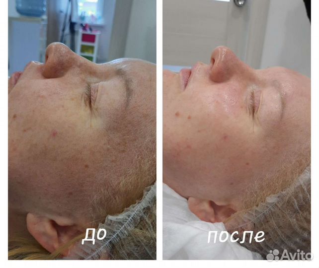 Голливудская чистка лица