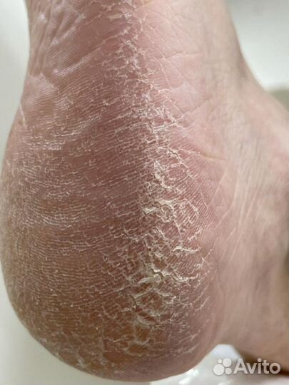 Консультация подолога бесплатно