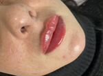 Обучение контурной пластике губ, ботокс Full Face