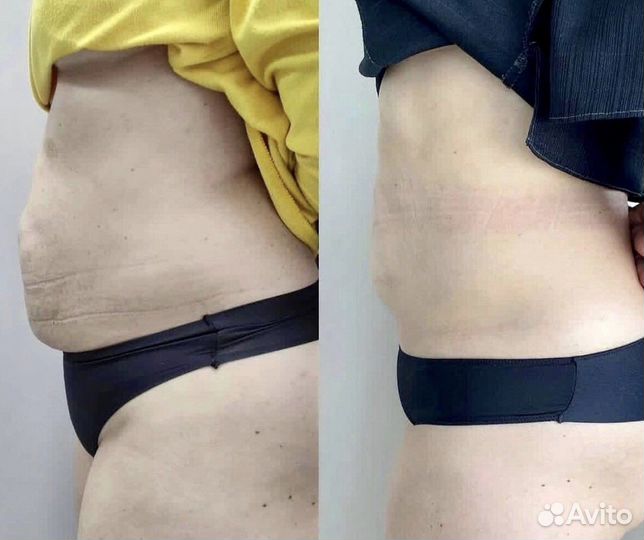 Липолитики