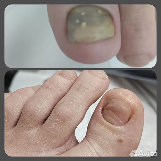 Подолог.Маникюр,Педикюр:неправильный ноготь,мозоли