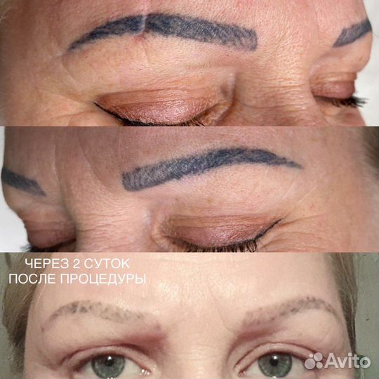 Удаление тату татуировок татужа, модель