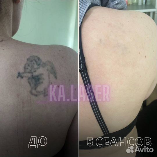 Лазерное Удаление тату и татуажа