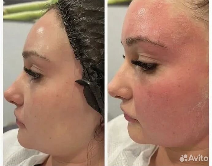 Микроигольчатый РФ лифтинг