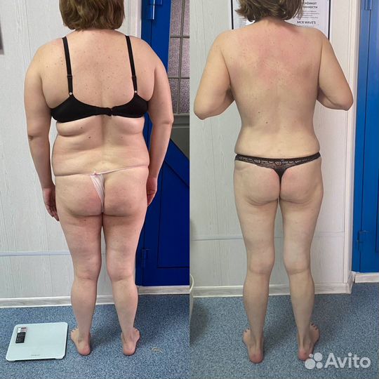 Антицеллюлитный массаж аппаратная коррекция LPG