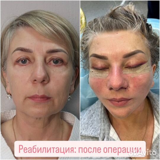 Блефоропластика, липофилинг