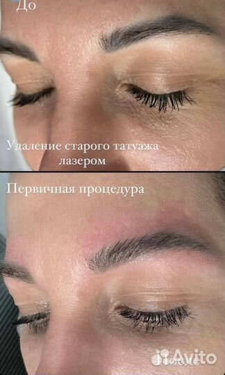 Модели на удаление тату и некачественного татуажа