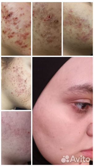 Косметолог лечение акне