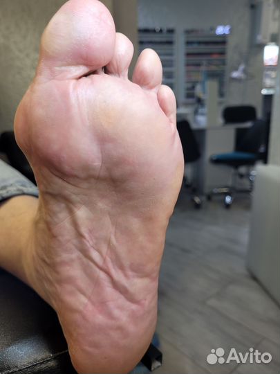 Педикюр, вросшие ногти, проблемные ногти