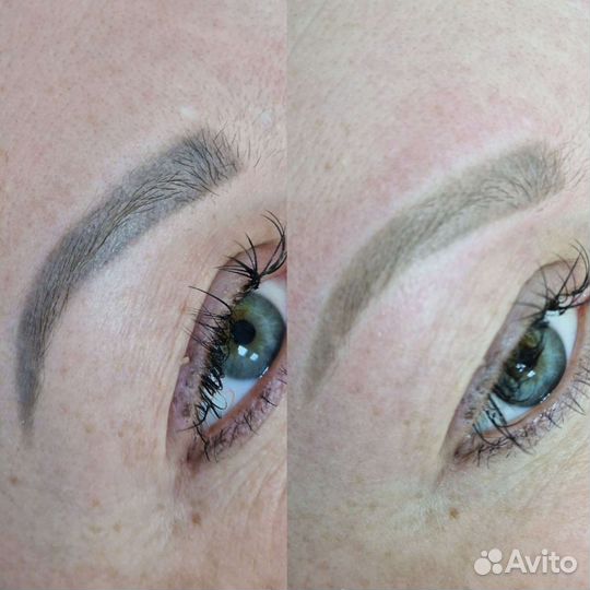 Лазерное удаление татуажа