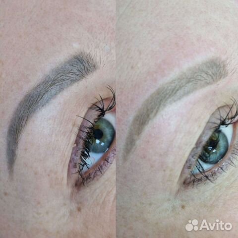 Лазерное удаление татуажа