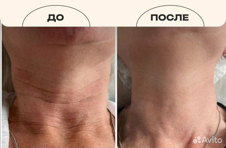 Холодная Плазма