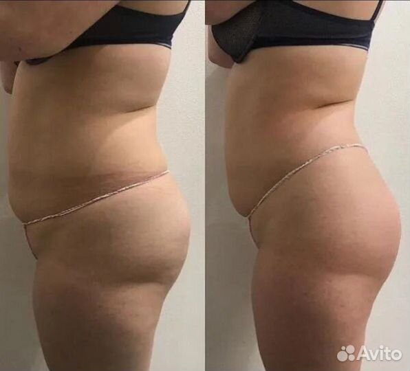 Модель на криолиполиз