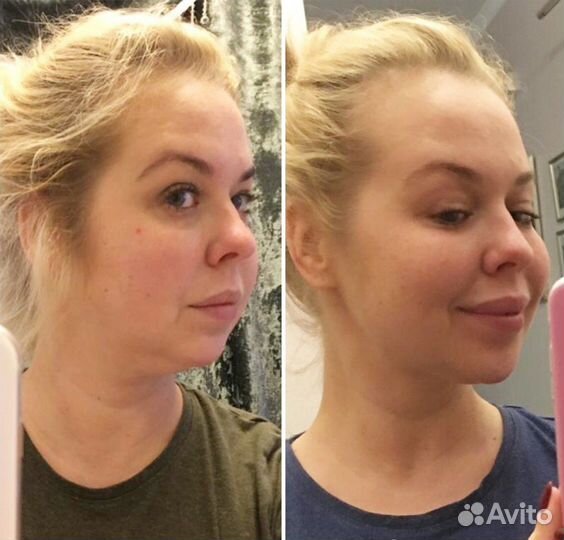 Смас лифтинг