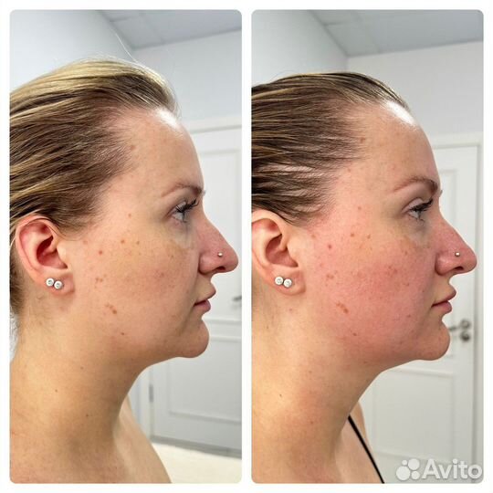 Скульптурный массаж лица