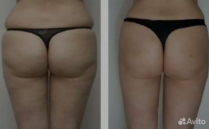 Карамельная липосакция. Обучение. Массаж. Ресницы