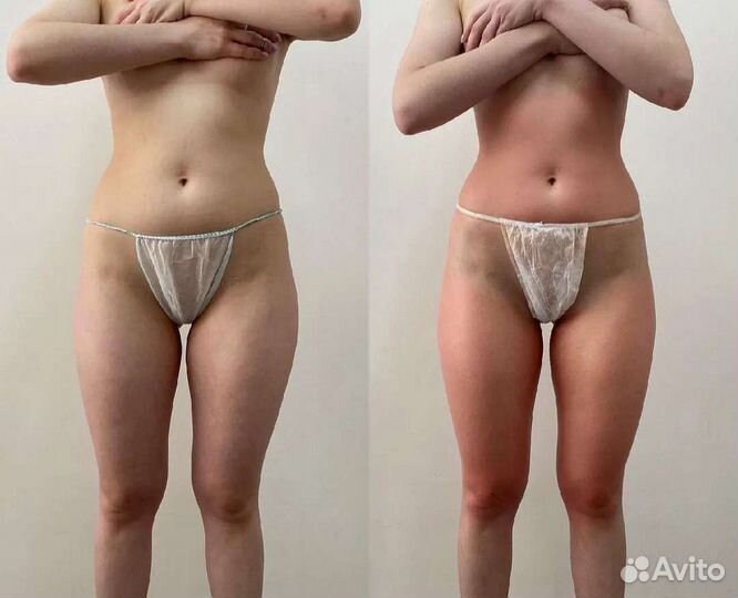 Аппаратная коррекция фигуры