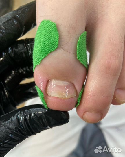 Установка коррекционной системы титановая нить