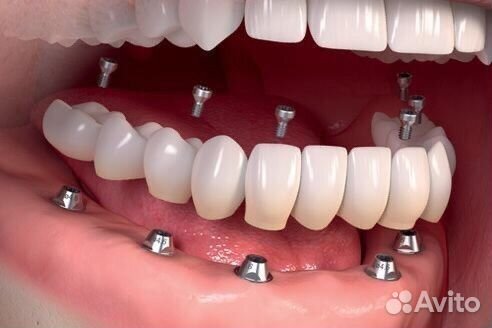 Импланты зубные