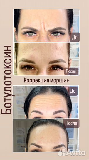Ботокс