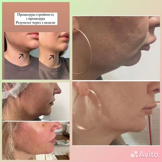 Увеличение губ Косметолог Нити Ког Акне Ботокс