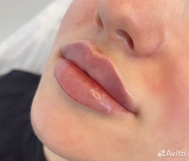 Модель на увеличение губ и биоревитализация