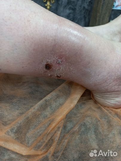 Карбокситерапия