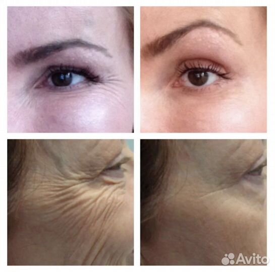 Требуются модели на ботокс