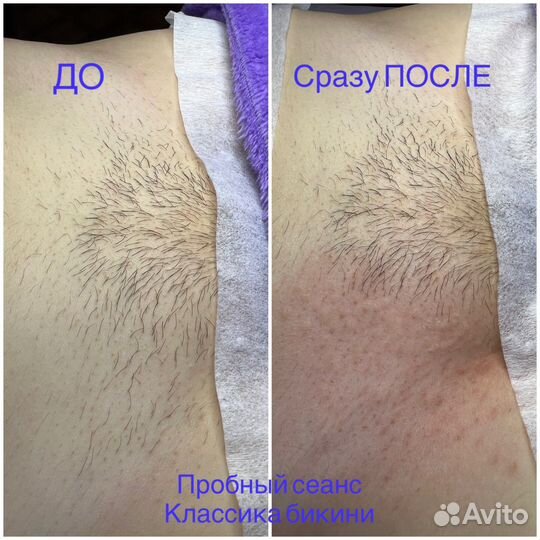 Электроэпиляция