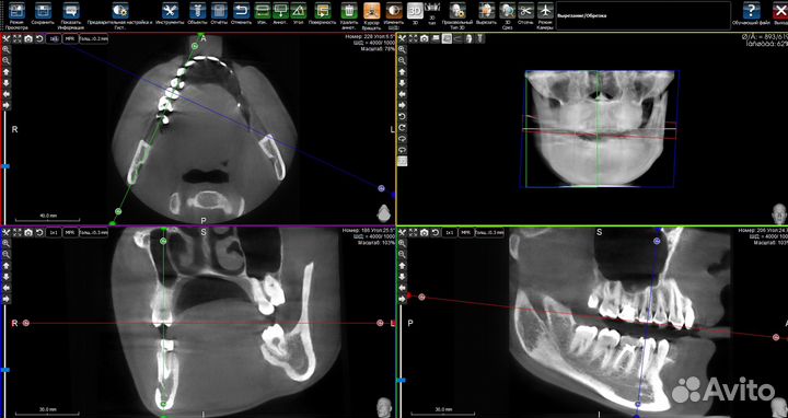 PlastyCad v.1.7&3Diagnosys v4.2