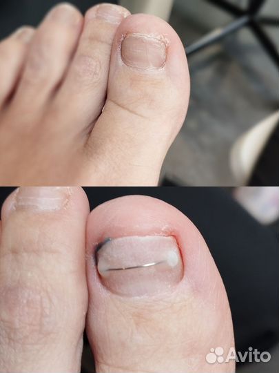 Установка титановой нити