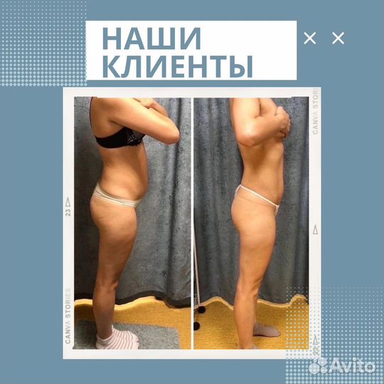 LPG массаж/ коррекция фигуры/ похудение