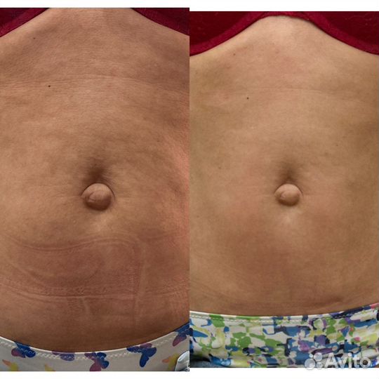 Антицеллюлитный массаж,коррекция фигуры