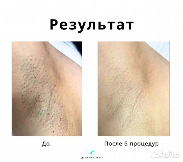 Диодный лазер Lumines Max’One 1200вт