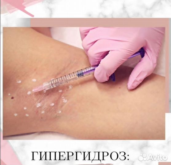 Лечение гипергидроза