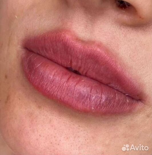 Косметолог/Увеличение губ/Ботокс