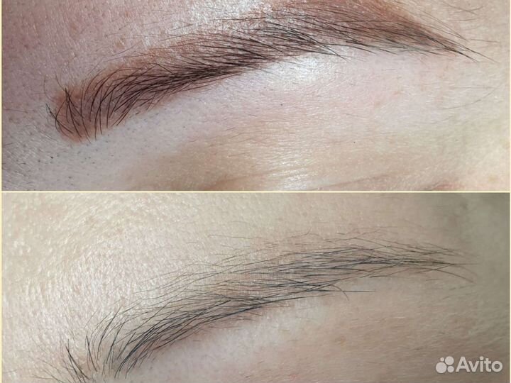 Удаление тату/татуажа