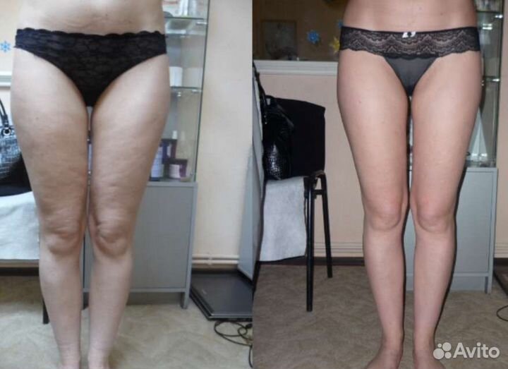 Антицеллюлитный массаж. Старвак. LPG. Похудение