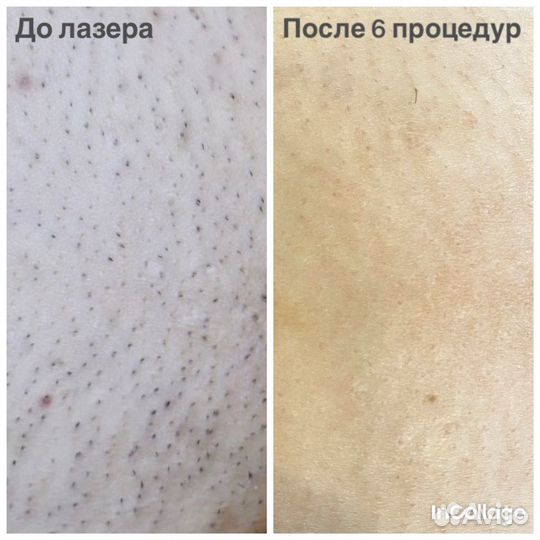 Шугаринг Лазерная эпиляция