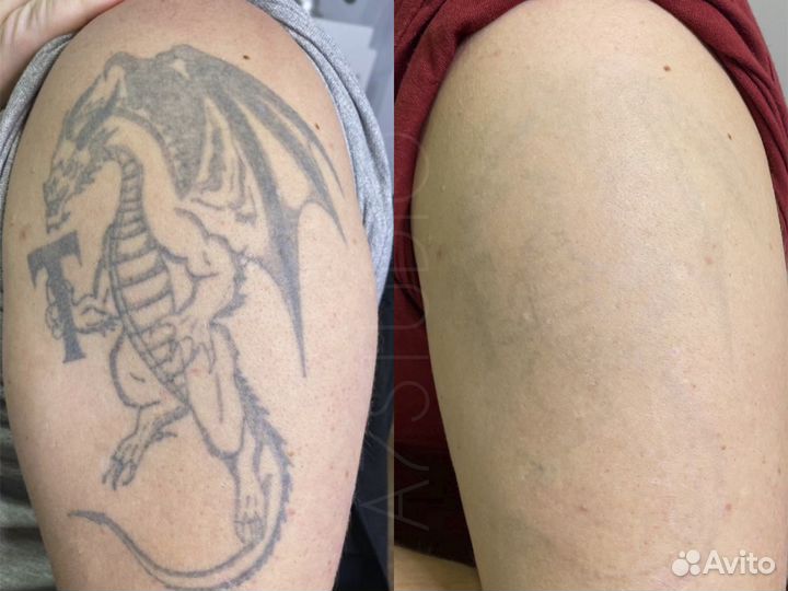 Удаление татуировок